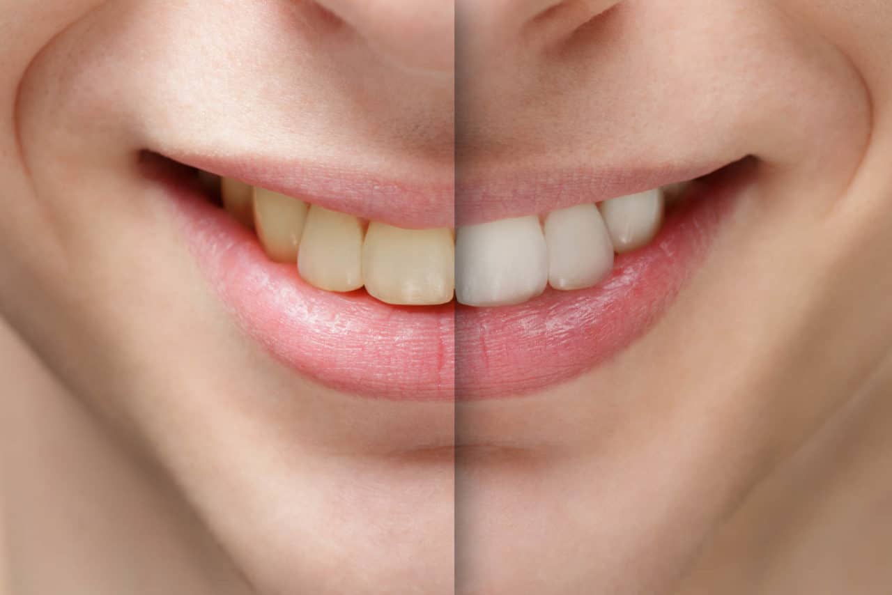 5 Tratamientos caseros para blanquear los dientes