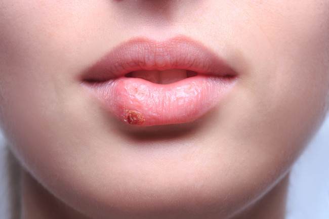 6 remedios naturales para el herpes labial