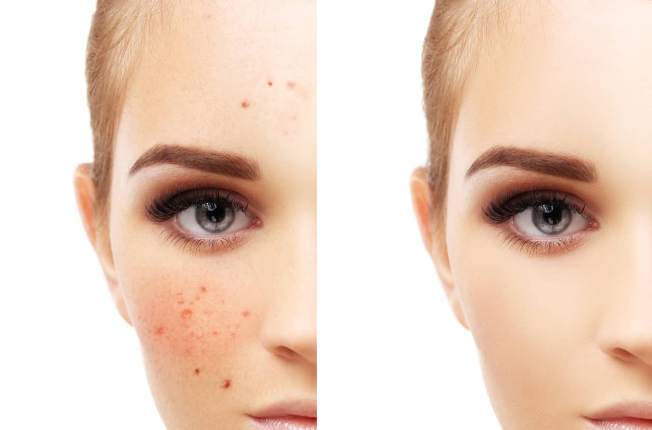 ¿Estás luchando contra el acné? Prueba este tratamiento de sal marina