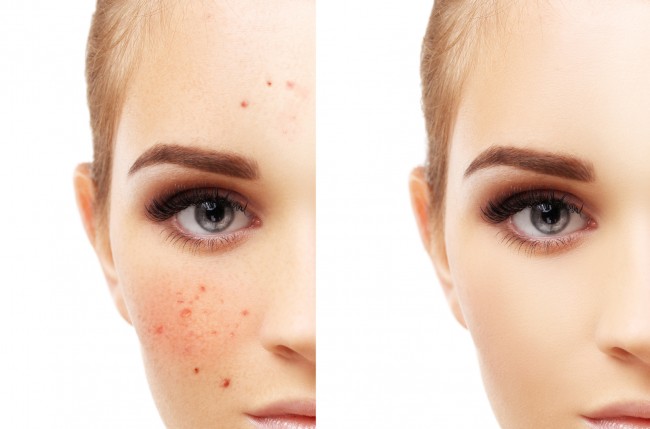 ¿Estás luchando contra el acné? Prueba este tratamiento de sal marina