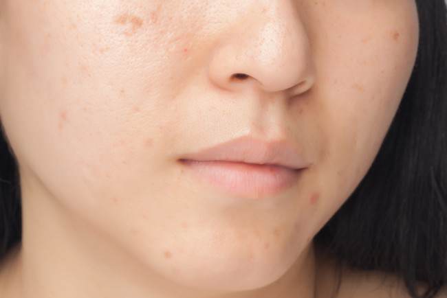 5 Tratamientos caseros para eliminar manchas en la cara