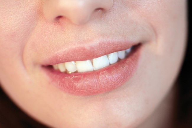 ¿Cómo tratar la resequedad de los labios?