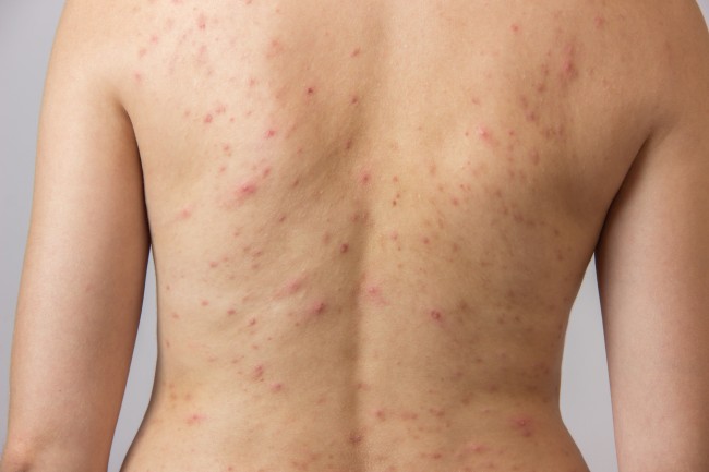 4 consejos para embellecer la espalda y evitar el acné