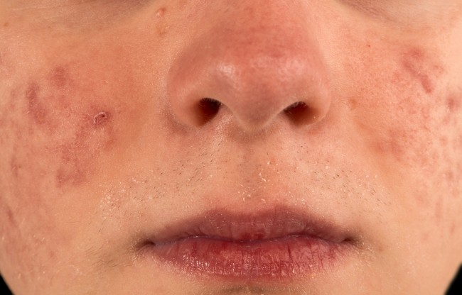 5 alternativas naturales para combatir las cicatrices del acné