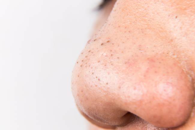 Los 4 remedios infalibles para remover las espinillas de la nariz
