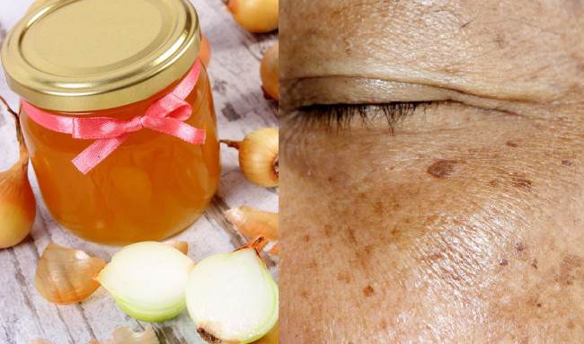 Preparado natural de miel y cebolla para aclarar la piel