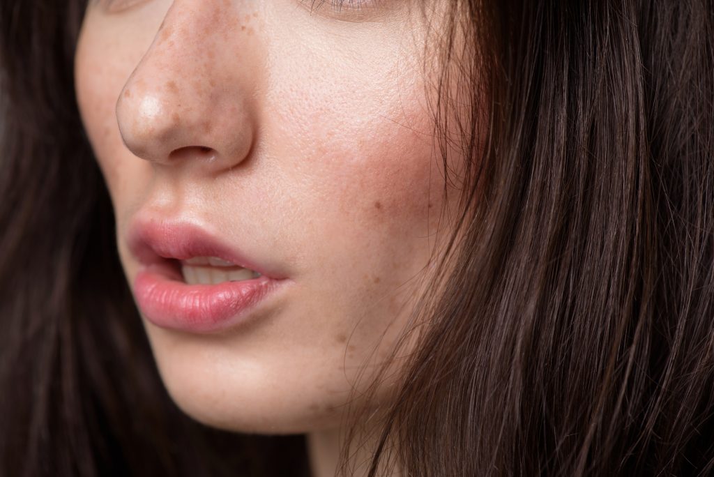 Cómo eliminar las molestas manchas del rostro
