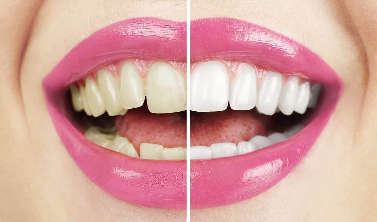 Cómo conseguir que tus dientes sean blancos de forma natural