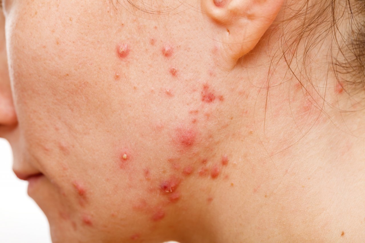 12 formas de combatir las afecciones más comunes de la piel