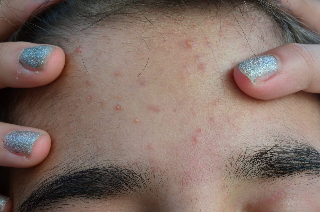 4 alternativas caseras para combatir el acné