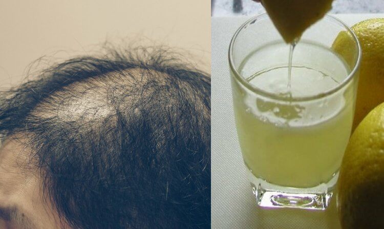 Cómo combatir la caída del cabello con jugo de limón
