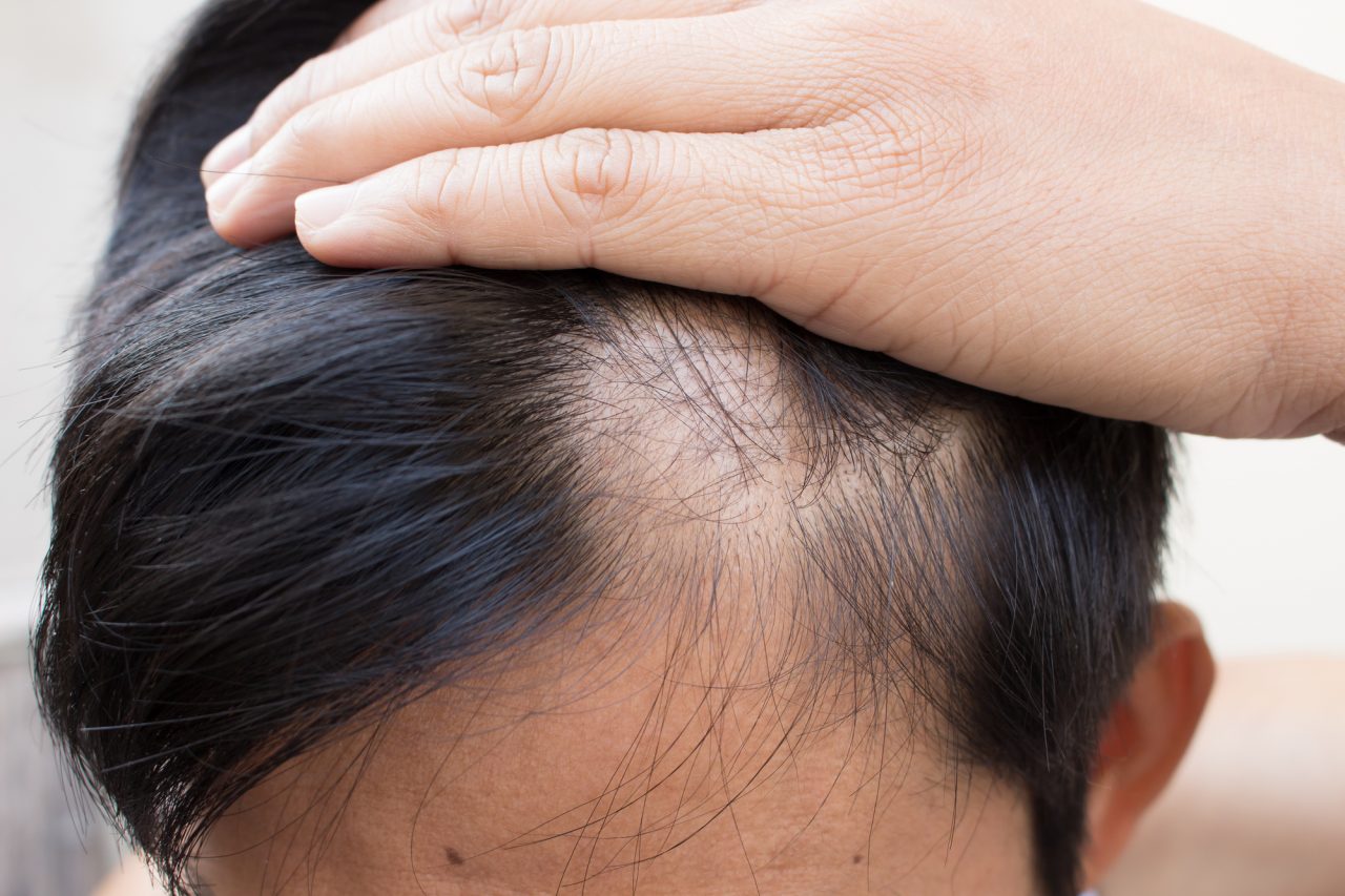 Cómo detener la caída del cabello con ingredientes naturales